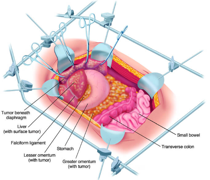 cancer peritoneal quimioterapia)