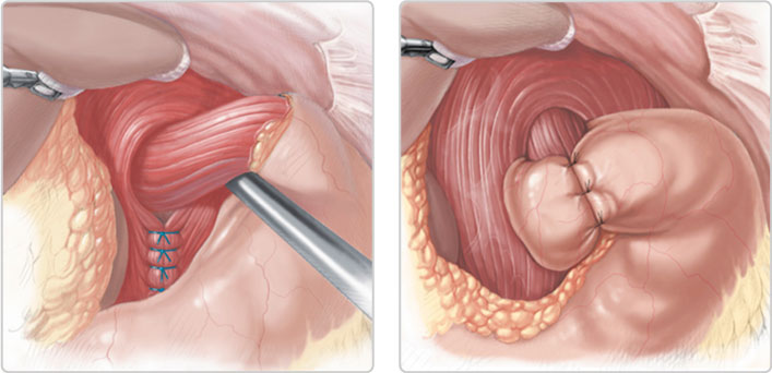 cirugia-esofagogastrica-esquema